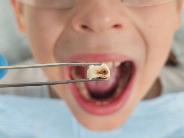 Best Emergency Root Canal Treatment in Hernando, FL