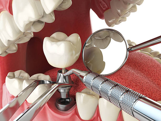 Best Emergency Dental Extractions in Hernando, FL